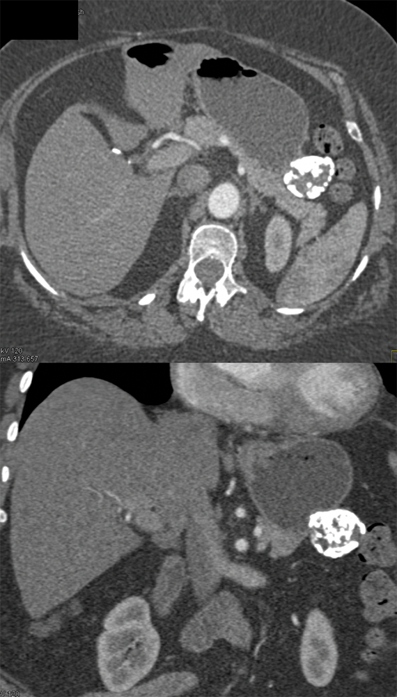 Gastric GIST Tumor