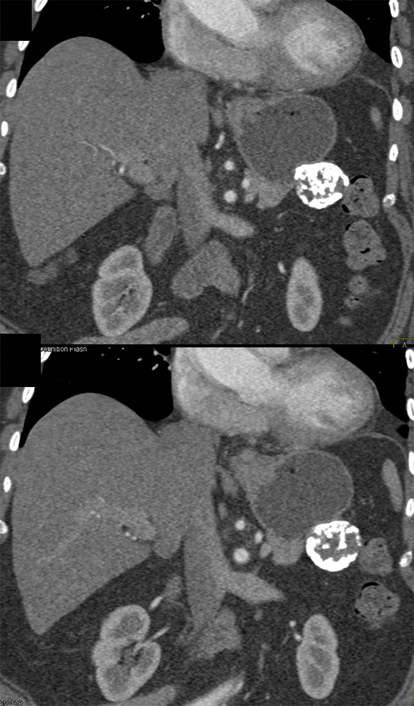 Gastric GIST Tumor