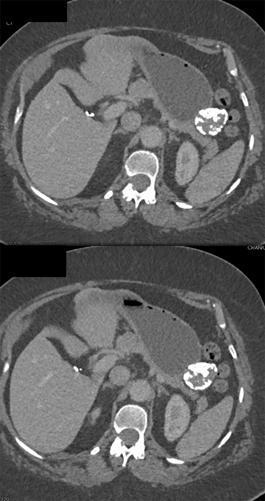 Gastric GIST Tumor