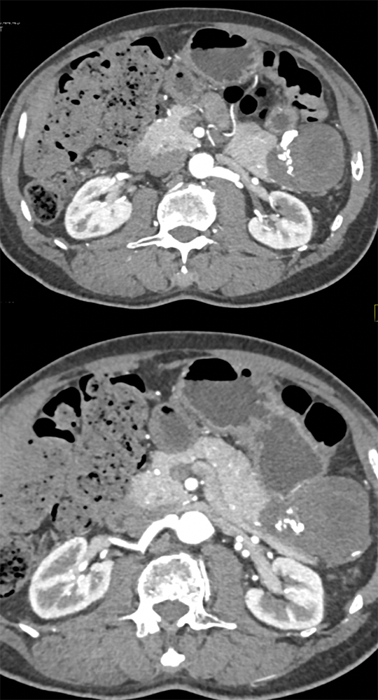 Gastric GIST Tumor