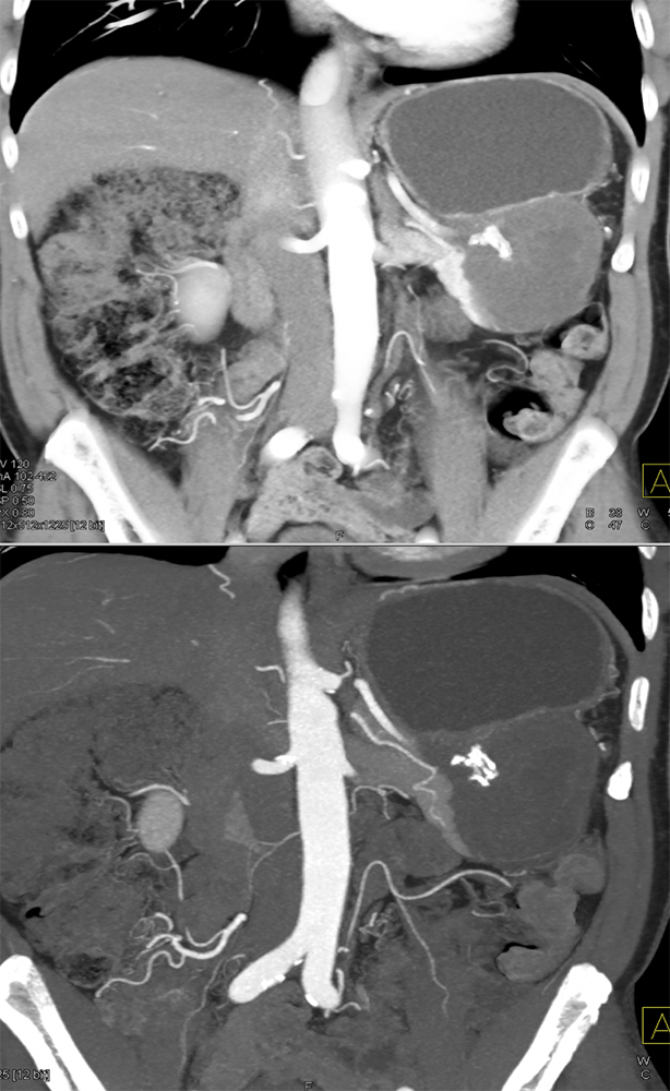 Gastric GIST Tumor