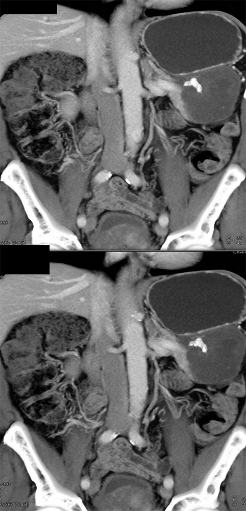 Gastric GIST Tumor