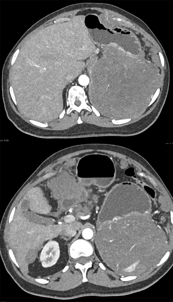 Gastric GIST Tumor with Spread