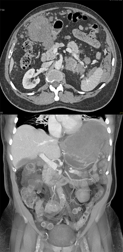 Gastric GIST Tumor with Spread