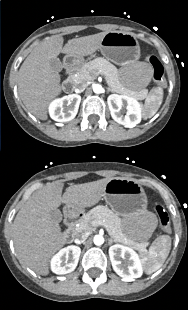 Gastric GIST Simulates Pancreatic Mass