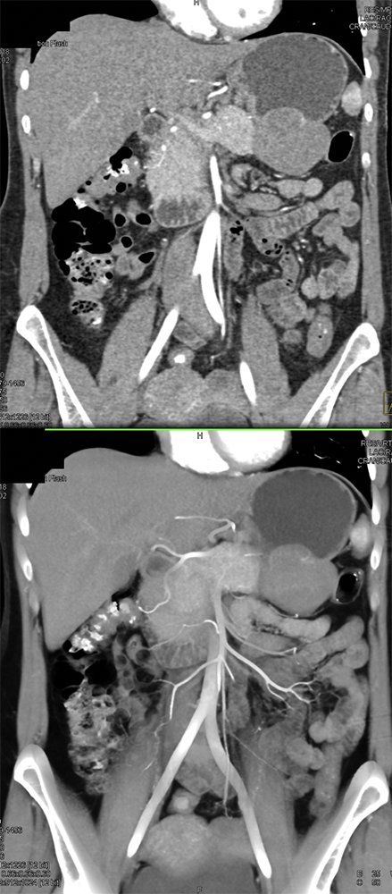 Gastric GIST Simulates Pancreatic Mass