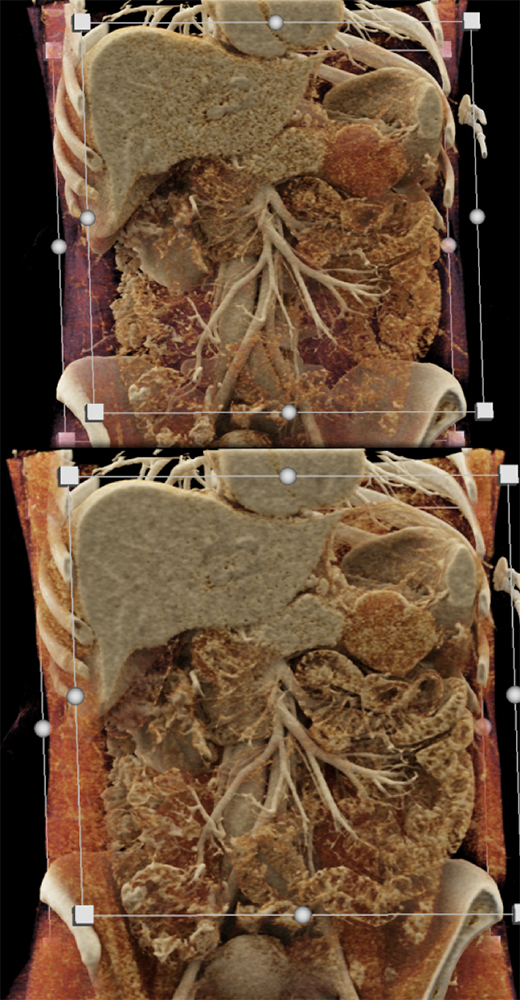 Gastric GIST Simulates Pancreatic Mass