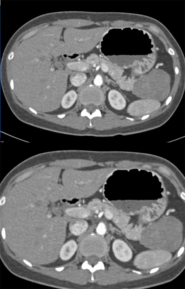 Gastric GIST Tumor Simulates a SPEN