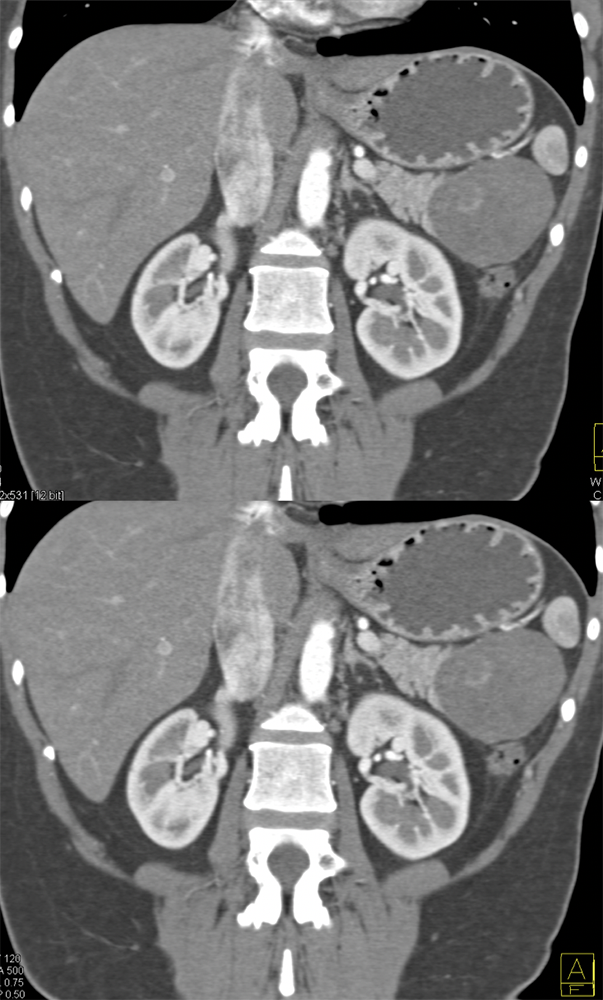 Gastric GIST Tumor Simulates a SPEN