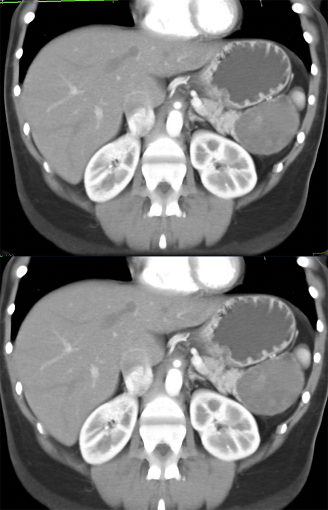 Gastric GIST Tumor Simulates a SPEN