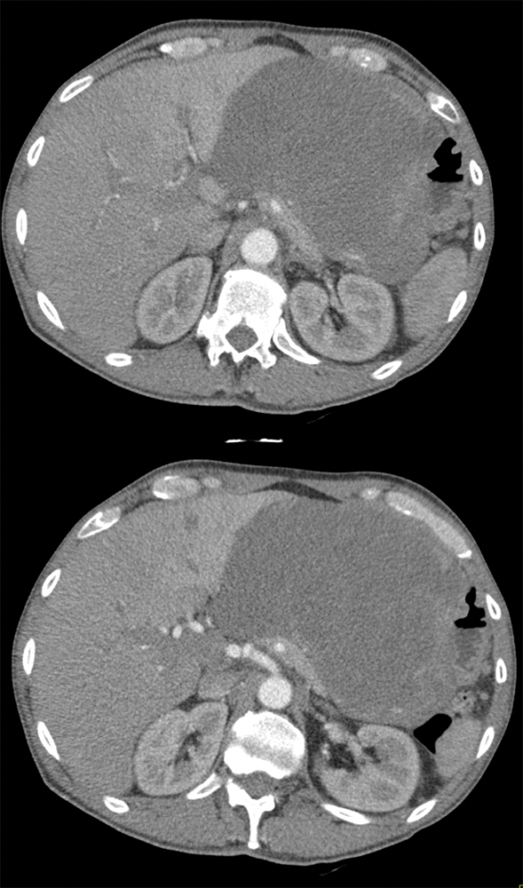 Liposarcoma Invades the Stomach and Looks Like A GIST tumor