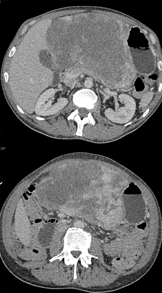 Liposarcoma Invades the Stomach and Looks Like A GIST tumor