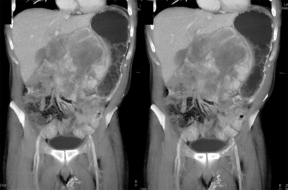 Liposarcoma Invades the Stomach and Looks Like A GIST tumor