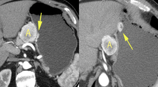 Carcinoid Tumor