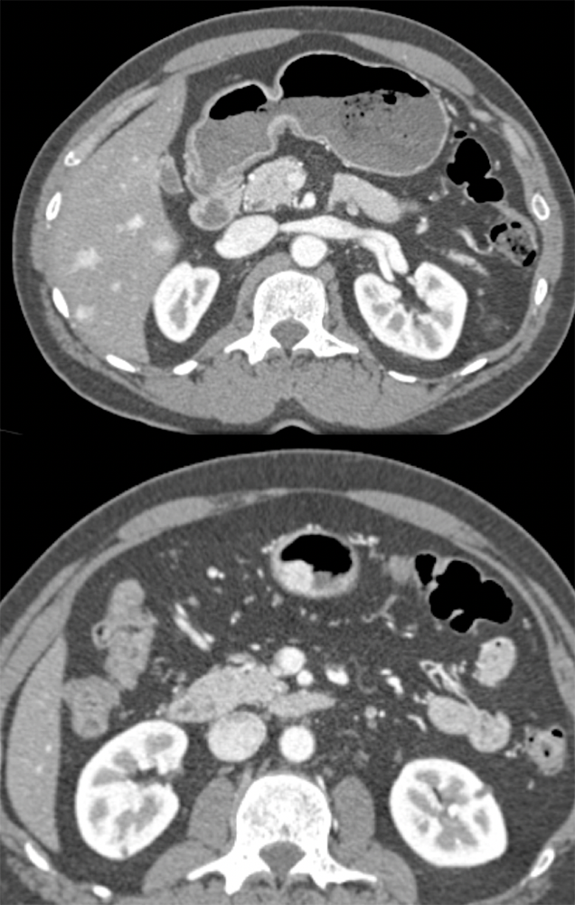 Gastric Carcinoid