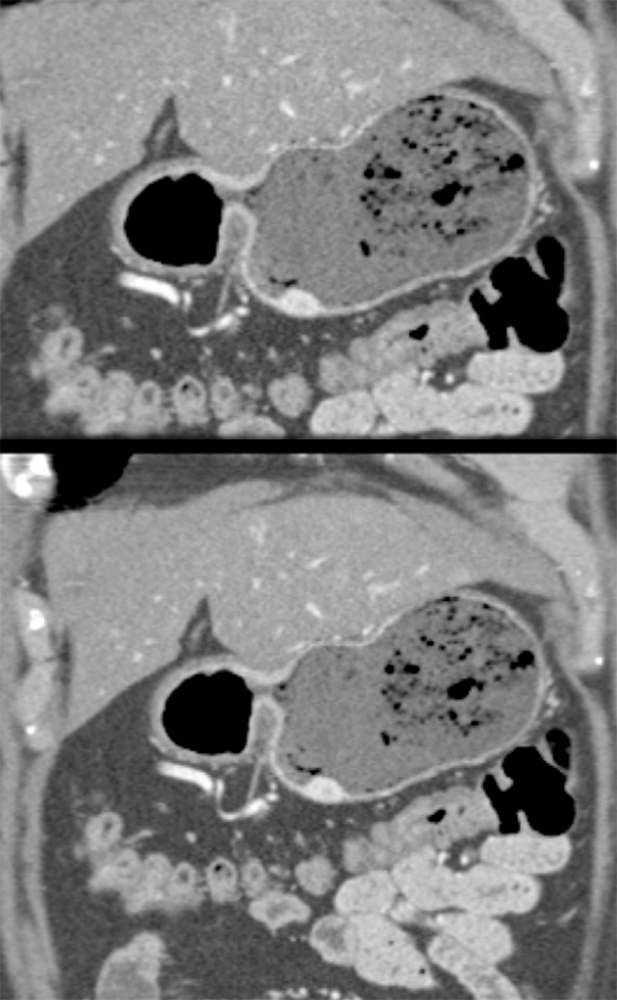 Gastric Carcinoid