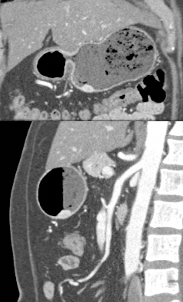 Gastric Carcinoid