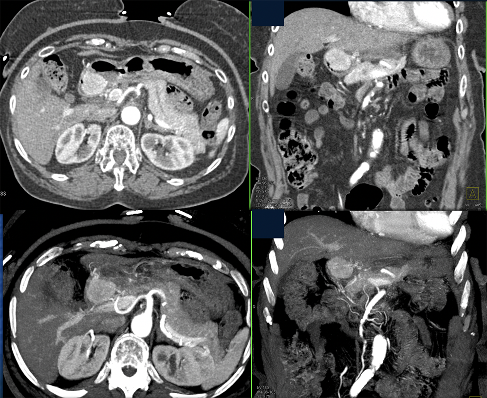 Gastric Carcinoid