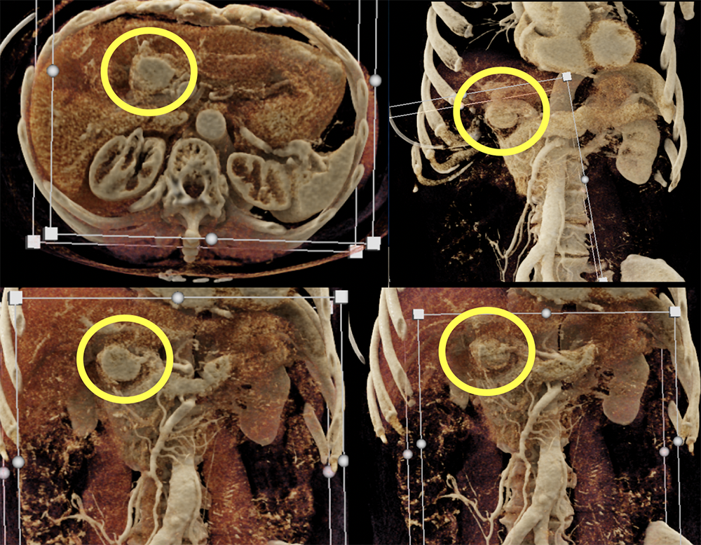 Gastric Carcinoid