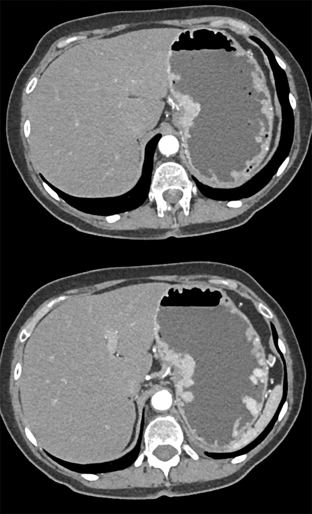 Gastric Carcinoid Tumors