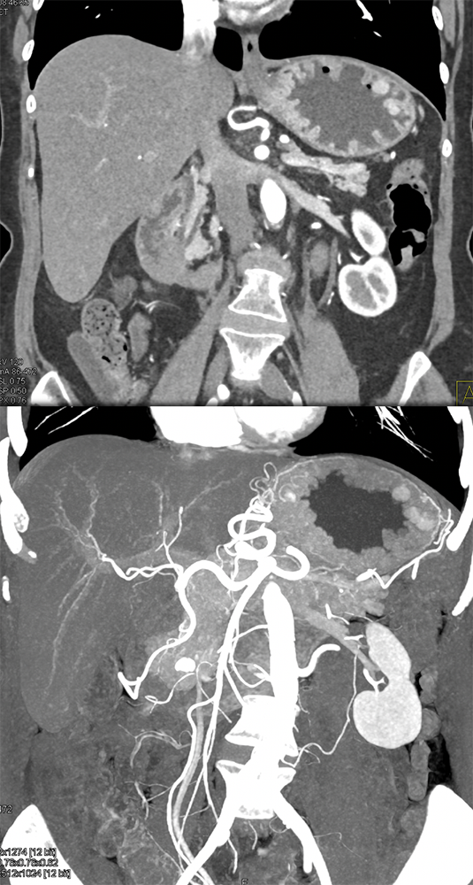 Gastric Carcinoid Tumors