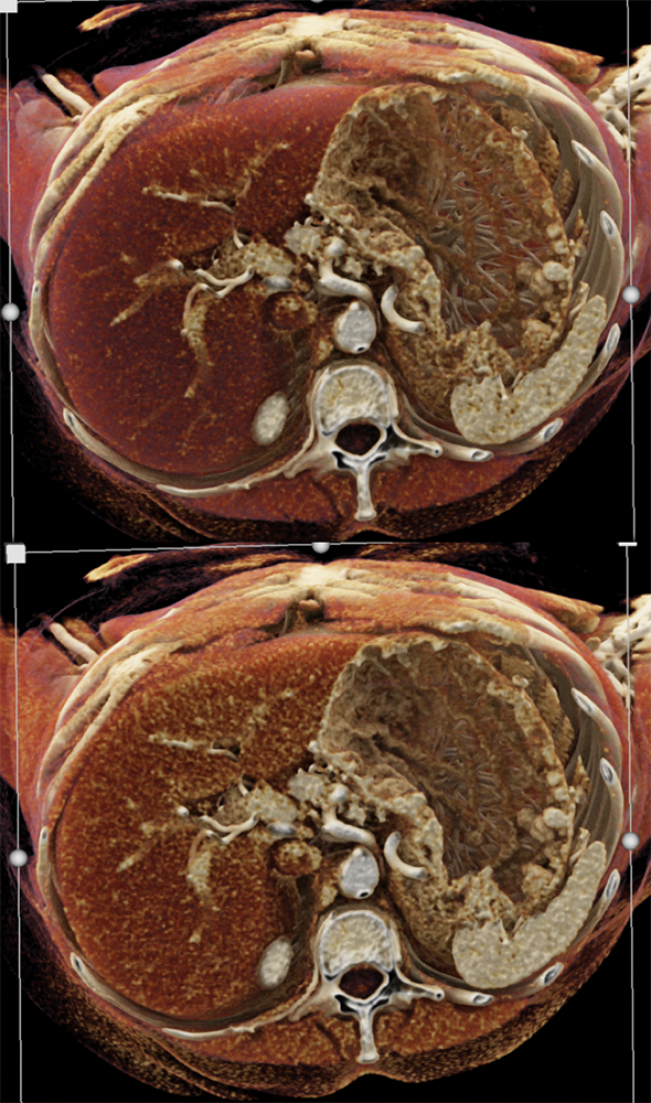 Gastric Carcinoid Tumors