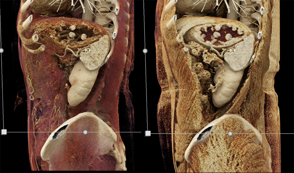 Gastric Carcinoid Tumors