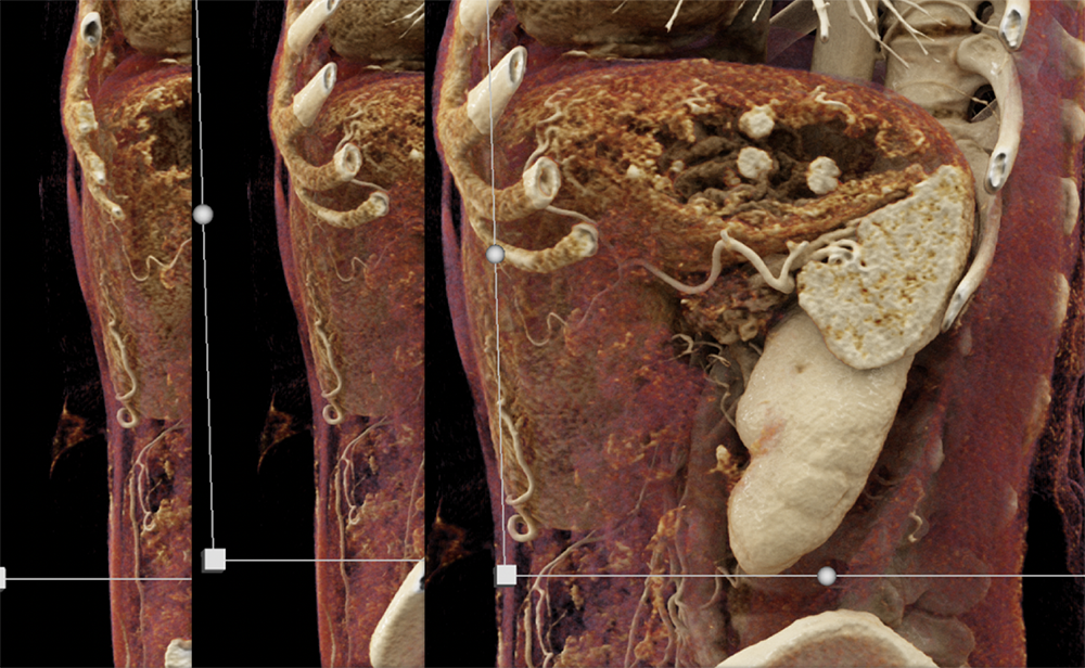 The CR nicely defines the enhancing Multiple Gastric Carcinoid Tumors