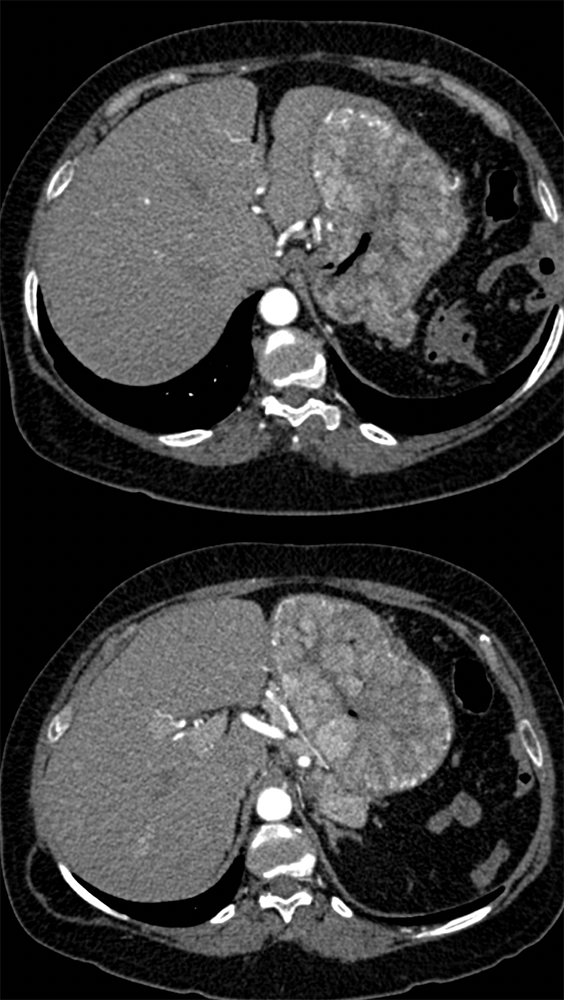 Gastrinoma with Stomach Carcinoids