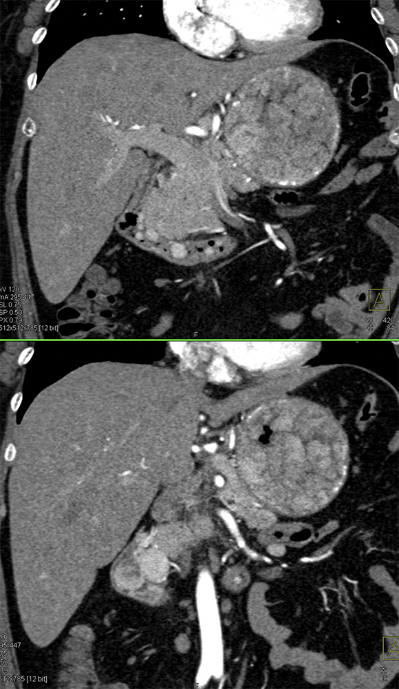 Gastrinoma with Stomach Carcinoids