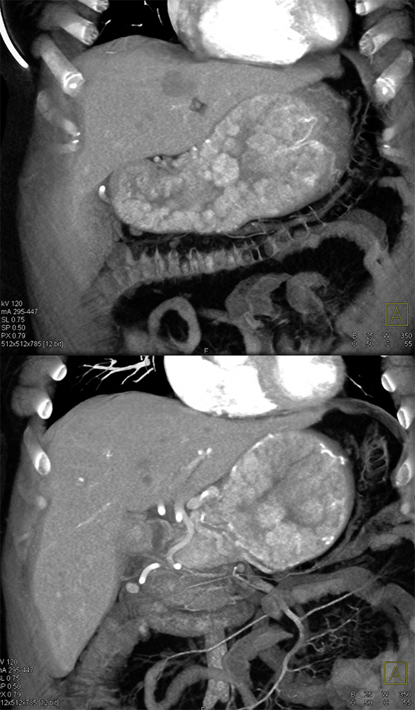 Gastrinoma with Stomach Carcinoids