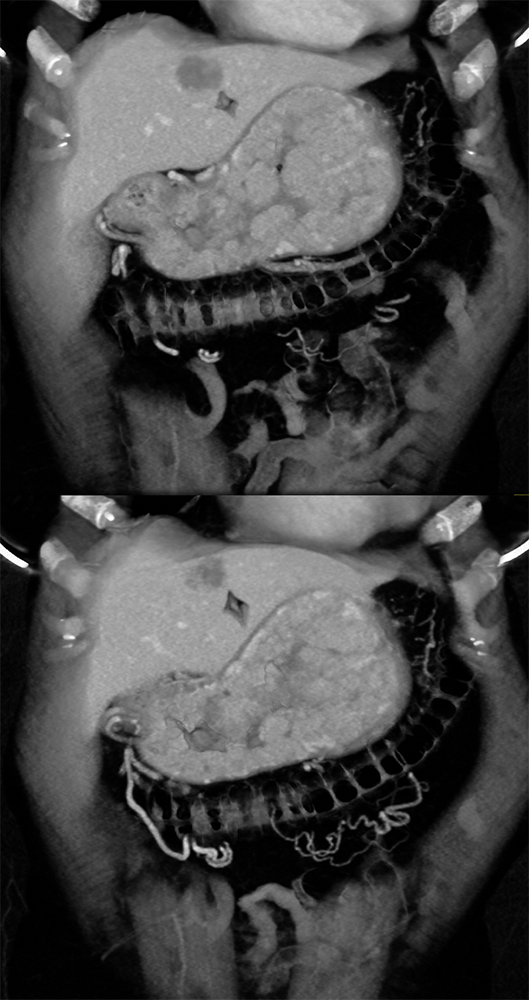 Gastrinoma with Stomach Carcinoids