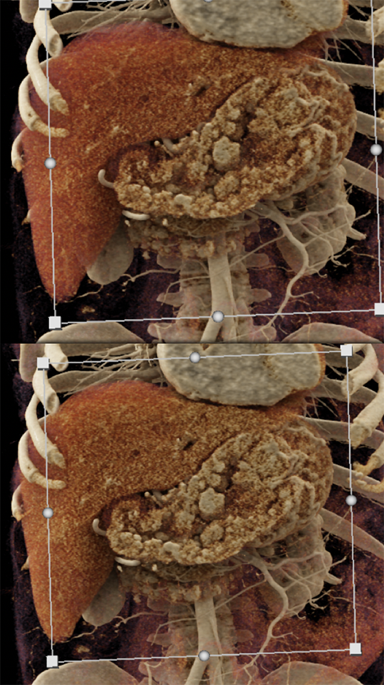 Gastrinoma with Stomach Carcinoids