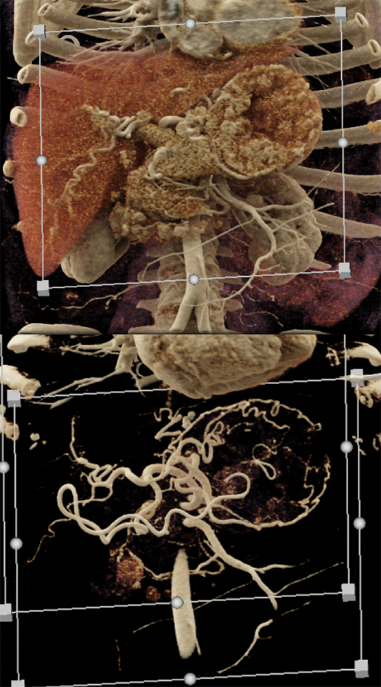 Gastrinoma with Stomach Carcinoids