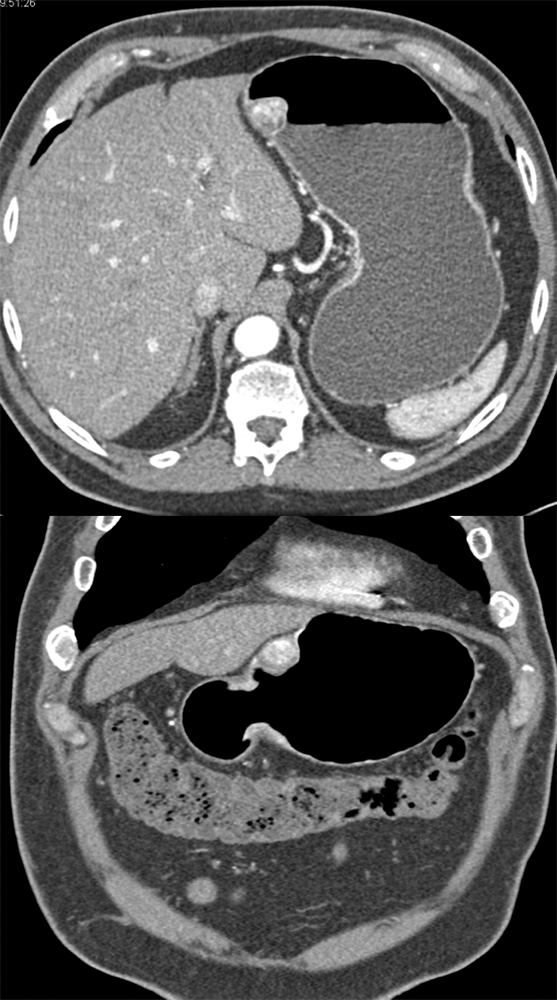 Vascular Gastric MassDx: Glomus tumor