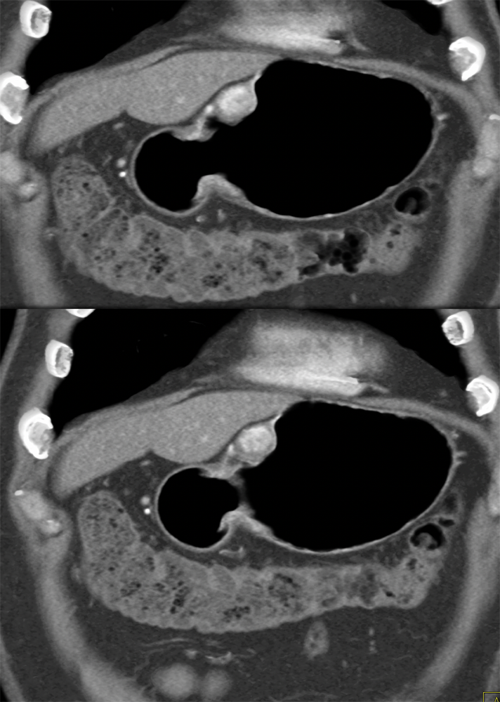 Vascular Gastric MassDx: Glomus tumor