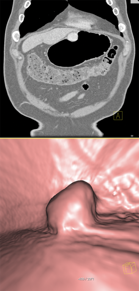 Vascular Gastric MassDx: Glomus tumor