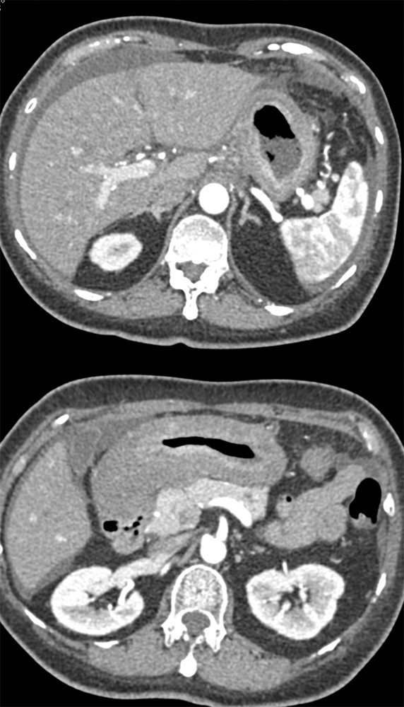 Metastatic Breast Cancer to the Stomach with Linitis Plastica