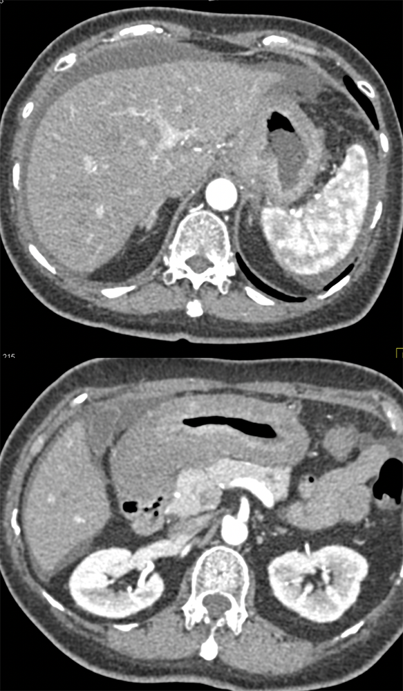 Metastatic Breast Cancer to the Stomach with Linitis Plastica