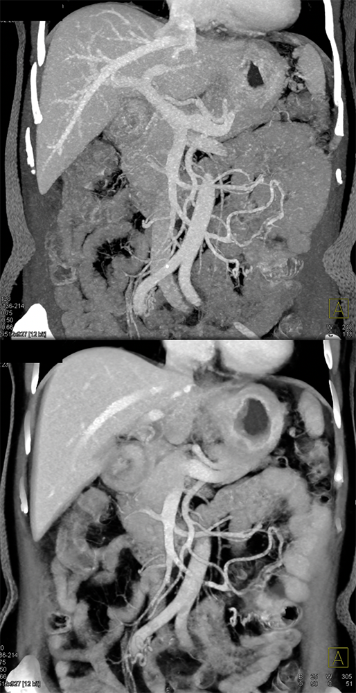 Metastatic Breast Cancer to the Stomach with Linitis Plastica