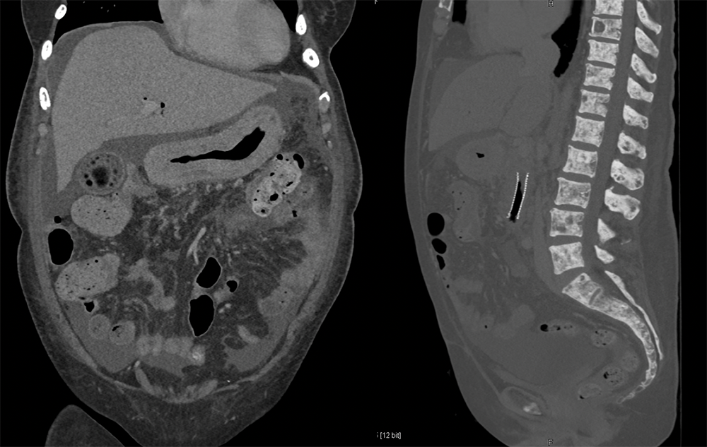 Linitis Plastica and Breast Cancer