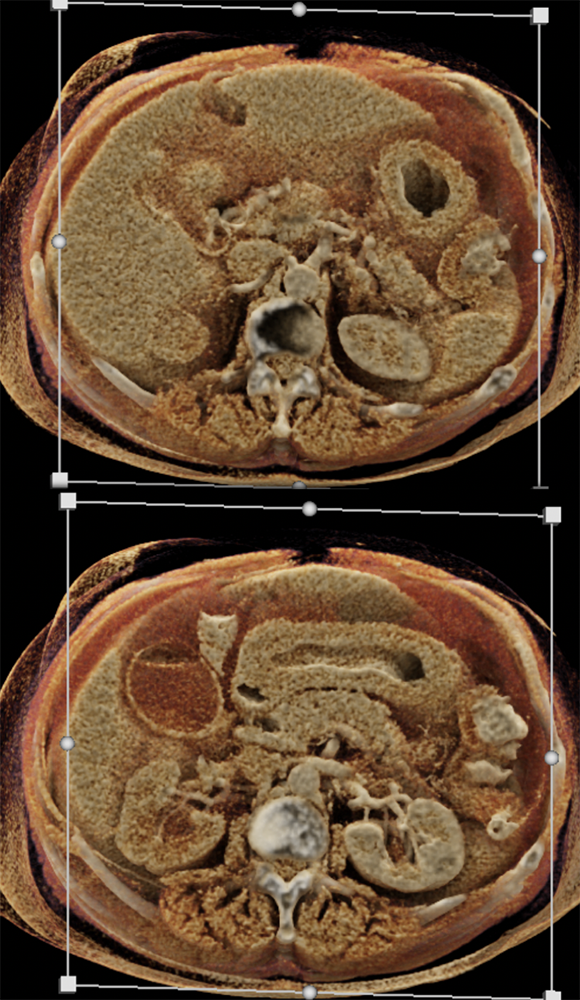 Linitis Plastica and Breast Cancer