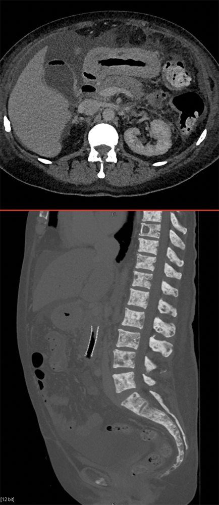 Linitis Plastica and Breast Cancer