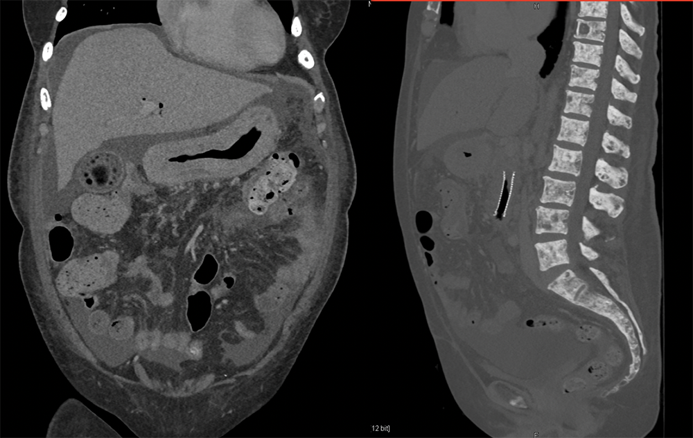 Linitis Plastica and Breast Cancer