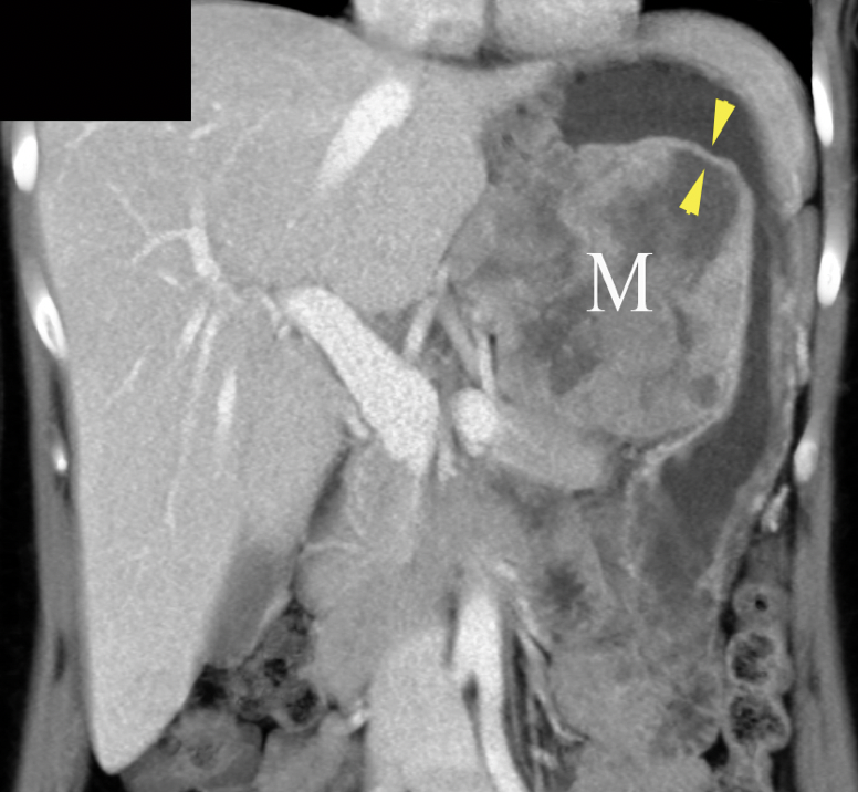 Metastatic Melanoma