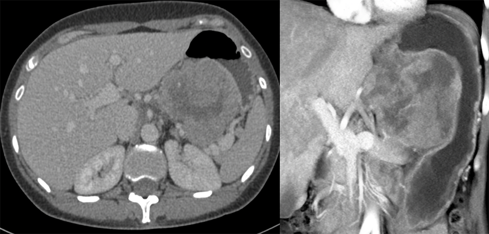 Metastatic Melanoma