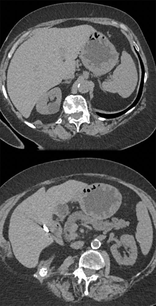 Suspected GI Bleed