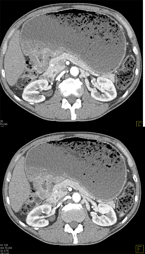 Gastric Adenocarcinoma with Gastric Outlet Obstruction