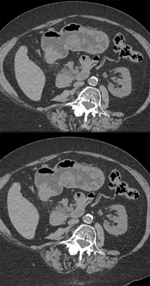 Suspected GI Bleed