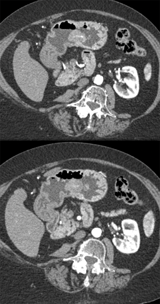 Suspected GI Bleed